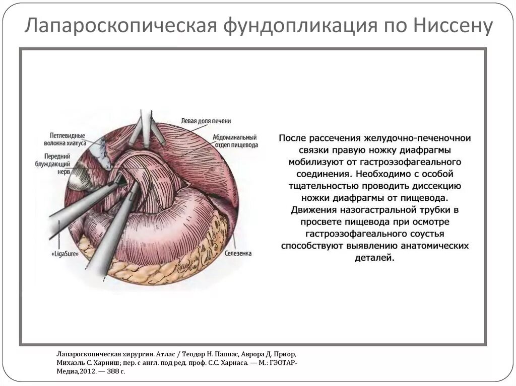 Питание после грыжи. Фундопластика по Ниссену. Фундопликация диафрагмы. Устранение грыжи диафрагмы, фундопликация по Ниссену. Фундопликация по Ниссену грыжа.