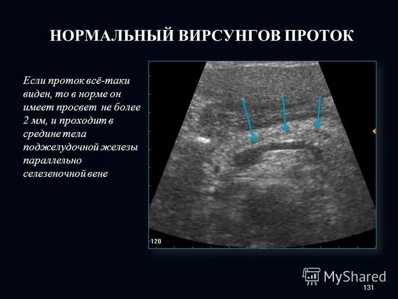 Расширение селезеночных вен