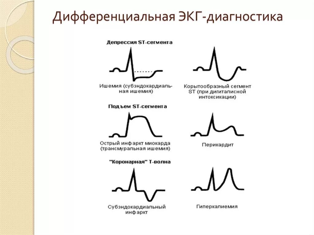 Эпизод депрессии st. Сегмент St на ЭКГ В норме и патологии. Депрессия St на ЭКГ. Корытообразный сегмент St на ЭКГ. Корытообразная депрессия сегмента St на ЭКГ.