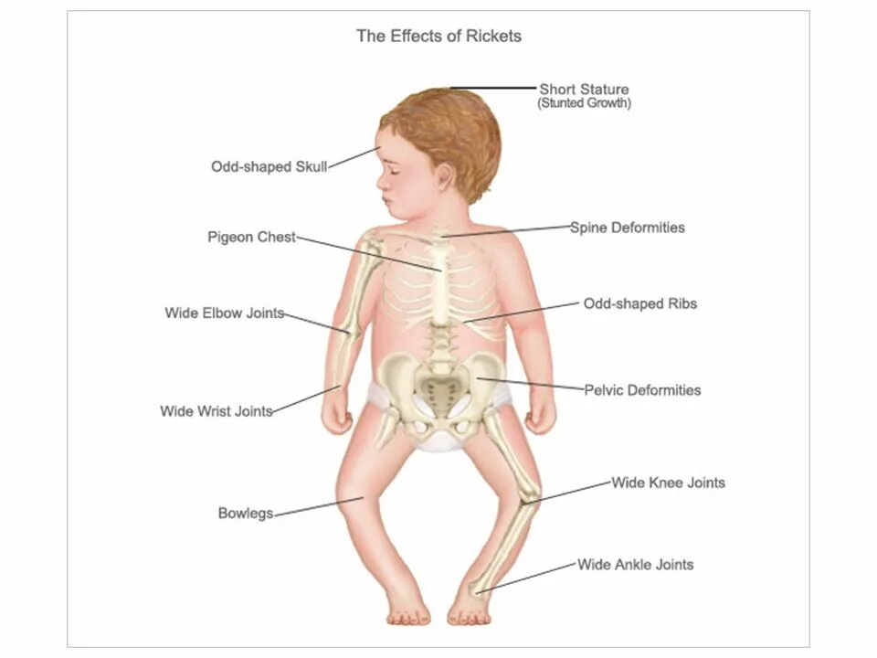 Грудная клетка ребенка 2 года. Подострый рахит симптомы. Дети с заболеванием рахит.