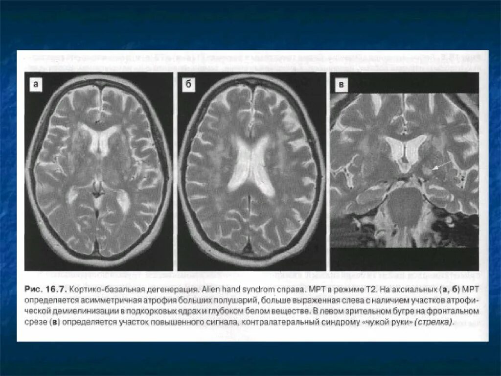 Лейкоэнцефалит. Лейкоэнцефалит