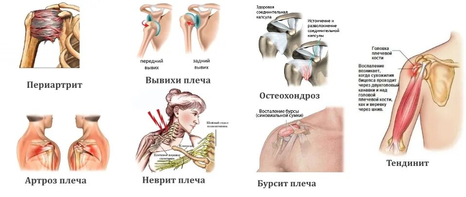 Сильно ноют плечи