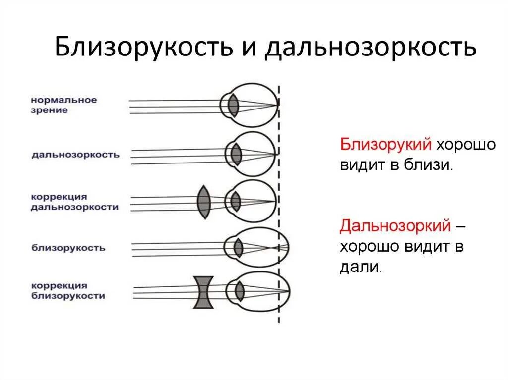 1 это нормальное зрение. Способы коррекции миопии гиперметропии. Способы коррекции близорукости и дальнозоркости. Нормальное зрение близорукость дальнозоркость схема. Дефекты зрения близорукость, дальнозоркость, астигматизм.