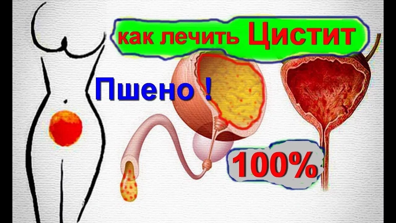 Сколько дней лечится цистит. Как вылечить цистит. Как вылечить цистит в домашних условиях. Цстти. Цистит у женщин народные средства.