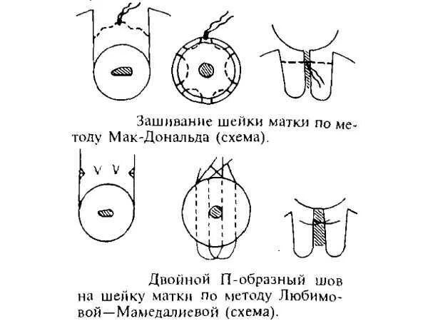 Матка 35 мм. Шейка матки длина 1.5 см. 30 Мм шейка матки норм. Шейка матки на 31 неделе беременности. Шейка матки при беременности 32 недели.