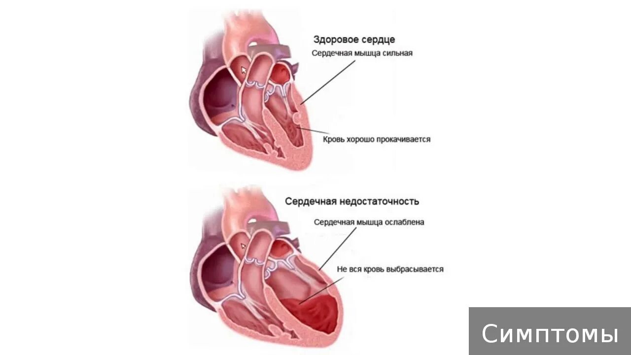 Как снять сердечную недостаточность. Застойной сердечной недостаточности. Застойная сердечная недостаточность 150. Сердце с сердечной недостаточностью. Сердце при острой сердечной недостаточности.