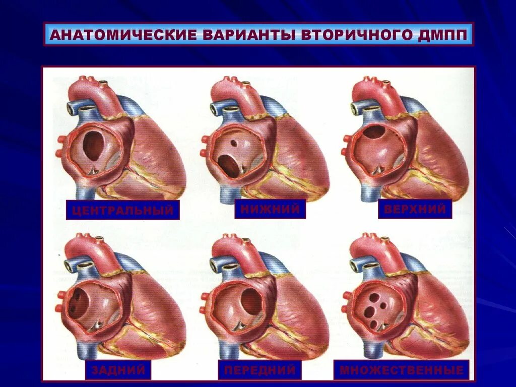 Врожденные аномалии сердца. Как выглядит порог сердца.