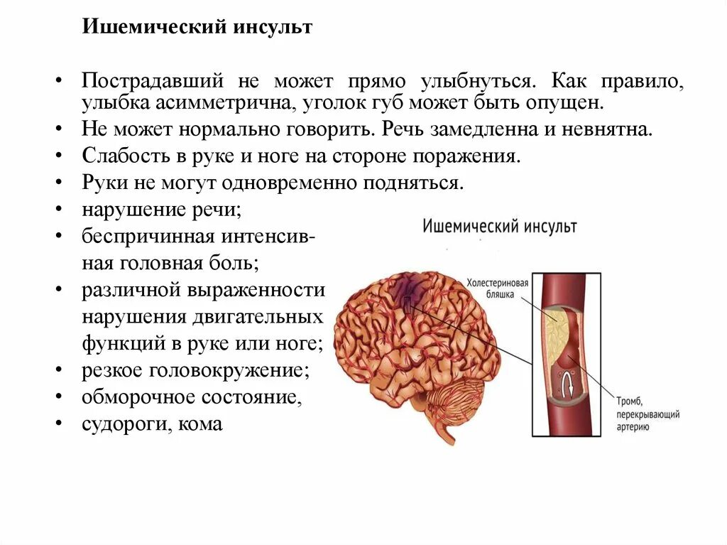 Ишемический инсульт симптомы. Начало ишемического инсульта. Что такое ишемический инсульт головного мозга