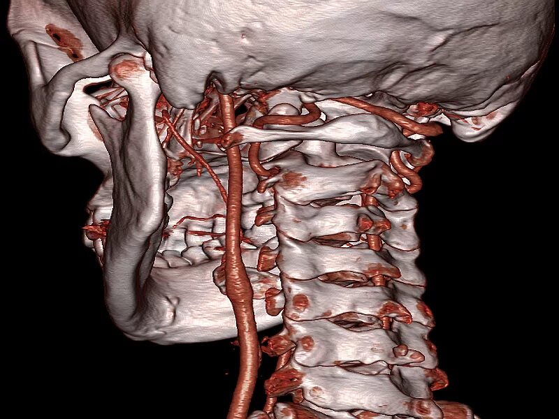Атлант и позвоночная артерия. Позвоночная артерия анатомия кт. Позвоночная артерия МСКТ. Позвоночная артерия шейного отдела.