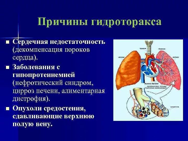 Гидроторакс клинические проявления. Клинические признаки гидроторакса. Болезни правосторонний гидроторакс. Гидроторакс патогенез схема. Дыхание при сердечной недостаточности