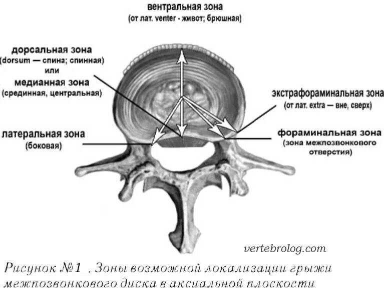Медианная грыжа межпозвонкового диска