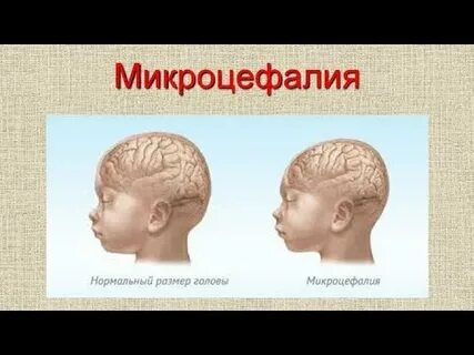 Микроцефалия умственная отсталость