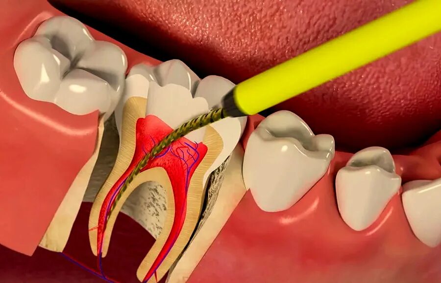 Воспаление канала зуба. 4 Канальный пульпит зуба. Двухканальный пульпит. Пульпит пломбировка каналов.