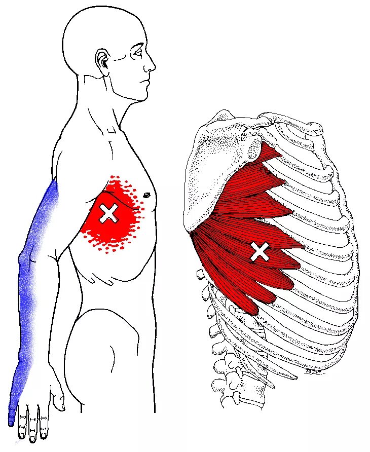 При вздохе болит правый. Триггерные точки грудной клетки. Триггерные точки мышцы грудной клетки. Миозит межреберных мышц.