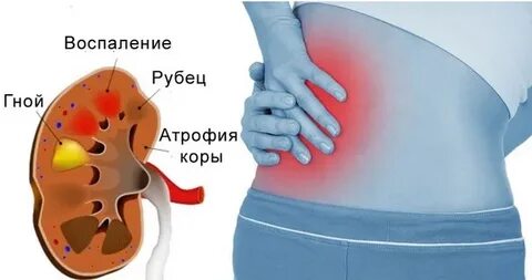 Пиелонефрит у женщин после