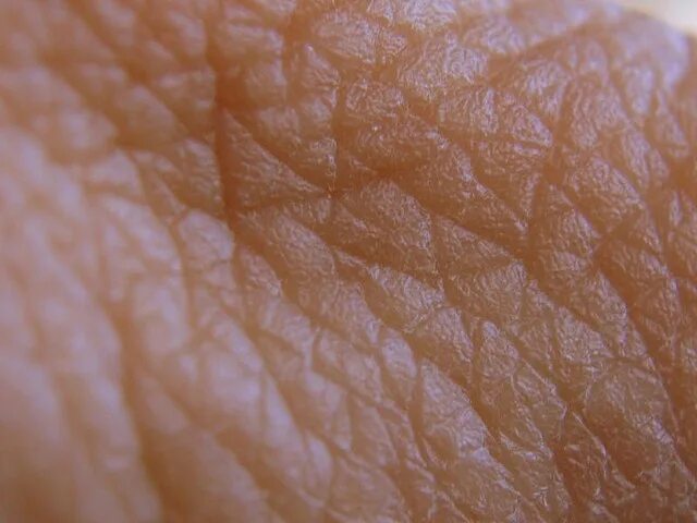 Почему морщатся руки. Заболевание кожа чешуя. Поверхность кожи покрыта бороздками.