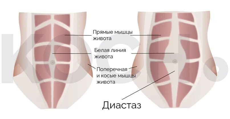 Как избавиться от диастаза мышц живота. Прямые мышцы живота диастаз. диастаз прямых мышц живота у женщин. диастаз прямых мышц живота на узи. диастаз прямых мышц живота фото.