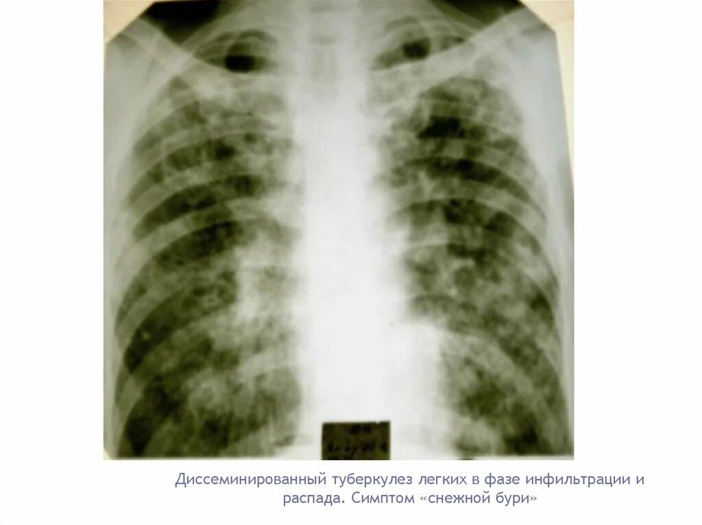 Острый диссеминированный туберкулез рентген. Диссеминированный инфильтративный туберкулез. Очаговый и диссеминированный туберкулез. Диссеминированный туберкулез на кт. Инфильтративный распад легких