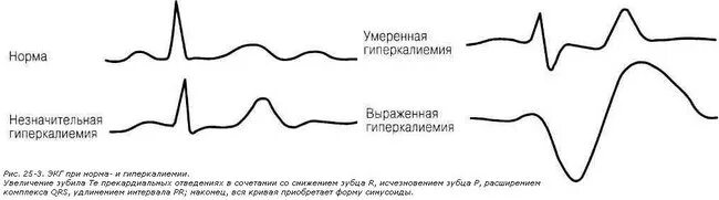 Гиперкалиемия признаки симптомы. Проявление гиперкалиемии на экг. гиперкалиемия экг на экг. экг при гипокалиемия. гипокалиемия и гиперкалиемия на экг.