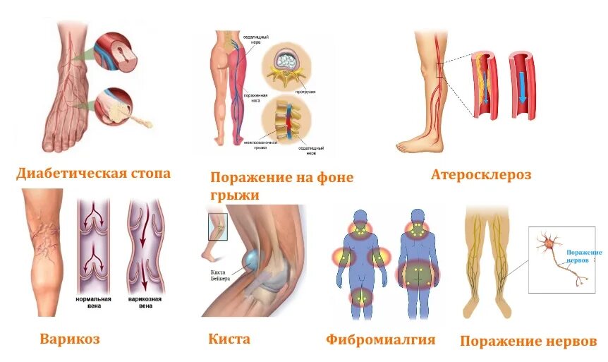 Слабая чувствительность голени. Онемение от колена до стопы.