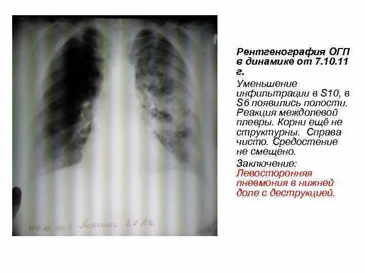 Без перифокальной реакции. Междолевая плевра справа рентген. Реакция плевры на рентгенографии. Рентгенография ОГП. Рентгенограмма в динамике.