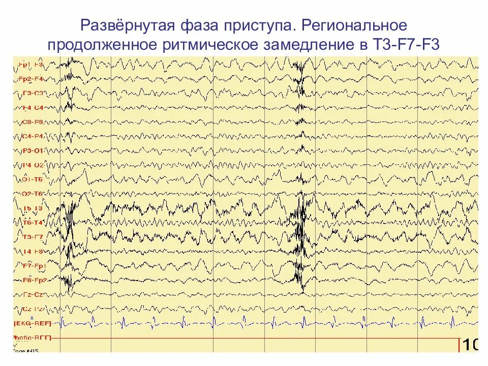 Региональное замедление на ЭЭГ. Регионарное замедление на ЭЭГ что это. Региональное замедление на ЭЭГ отражает. Дельта замедление на ЭЭГ.