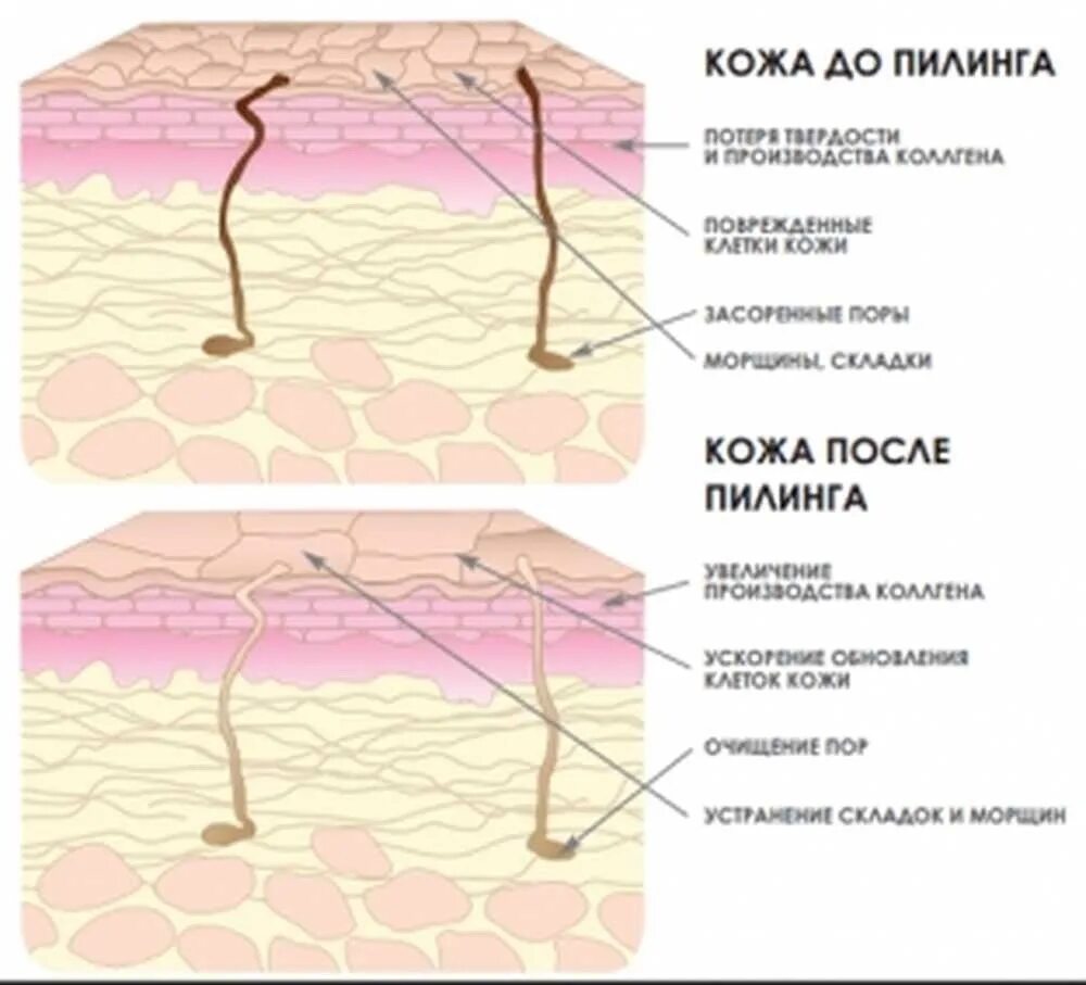 В собственно коже отсутствует пигмент. Отшелушивание рогового слоя эпидермиса кожи схема. Воздействие пилинга на кожу. Строение рогового слоя эпидермиса.