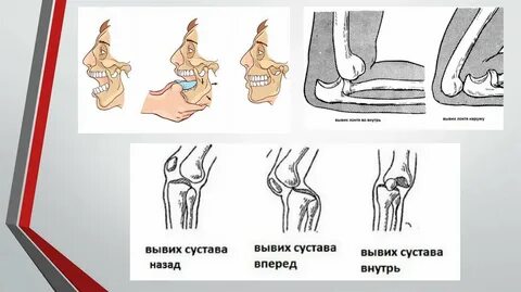 Карта вызова вывих