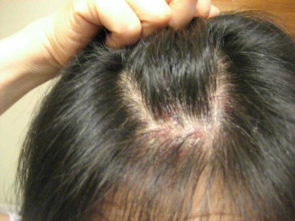 Сухие болезненные. Асбестовидный себорейный дерматит. Себорейный дерматит волосистой части. Себорейный дерматит на волосах.