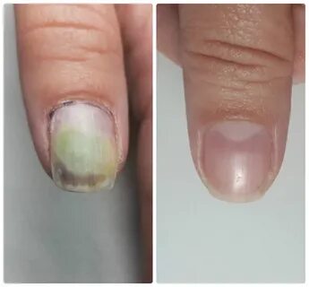 Онихолизис ногтей лечение лаком