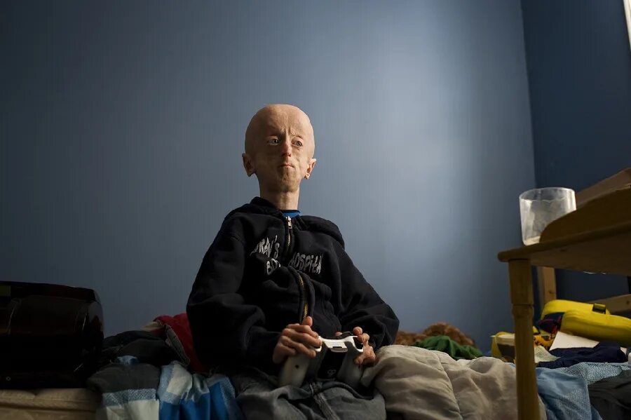 Прогерия взрослых синдром вернера. Люди с синдромом преждевременного старения. Прогерия екатерина неженцева. Синдром хатчинсона-гилфорда детская прогерия. Старение человека.