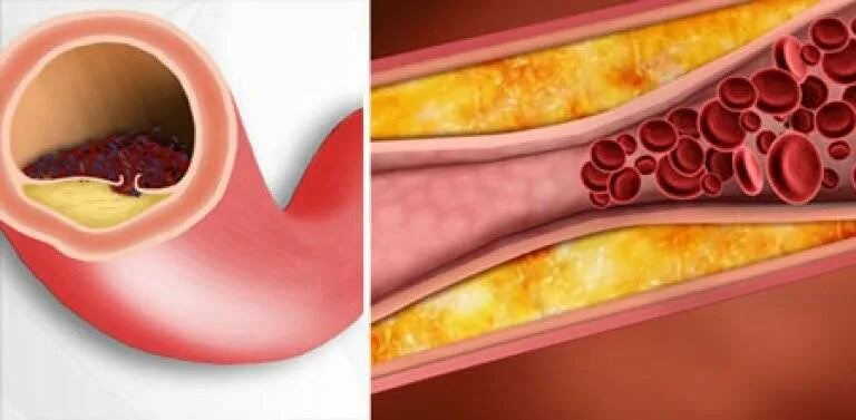 Холестериновые бляшки в сосудах. От бляшек и тромбов как очистить