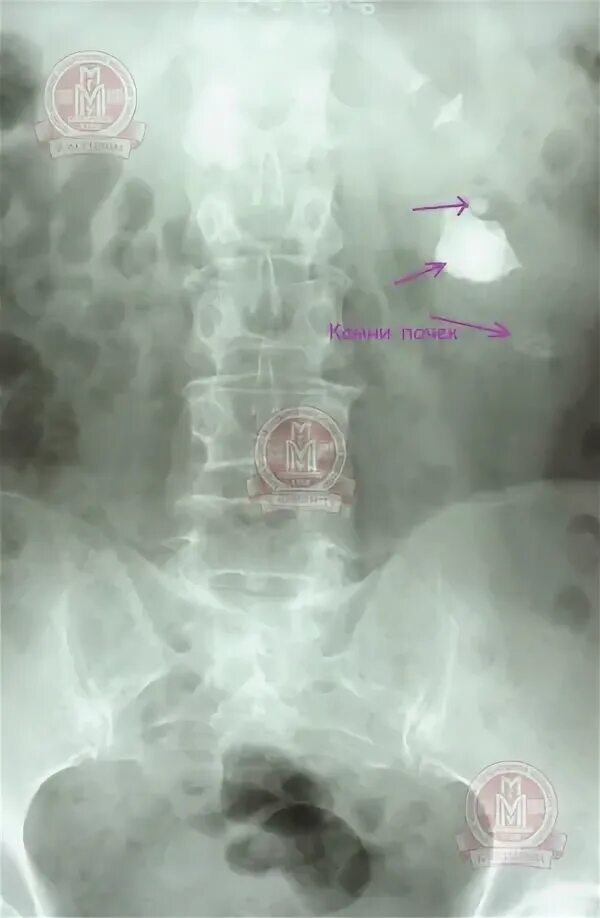 Камень в мочеточнике рентген. Коралловидный конкремент мочевого пузыря. Камень в мочеточнике 3.5 на 3мм. Камень в почке 3 мм