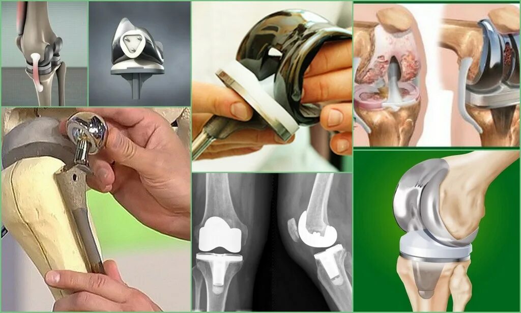 Коленный эндопротез Stryker. Эндопротез коленного сустава Maxx Orthopedics. Эндопротез коленного сустава Stryker. Ревизионный эндопротез коленного сустава. Замена сустава осложнения