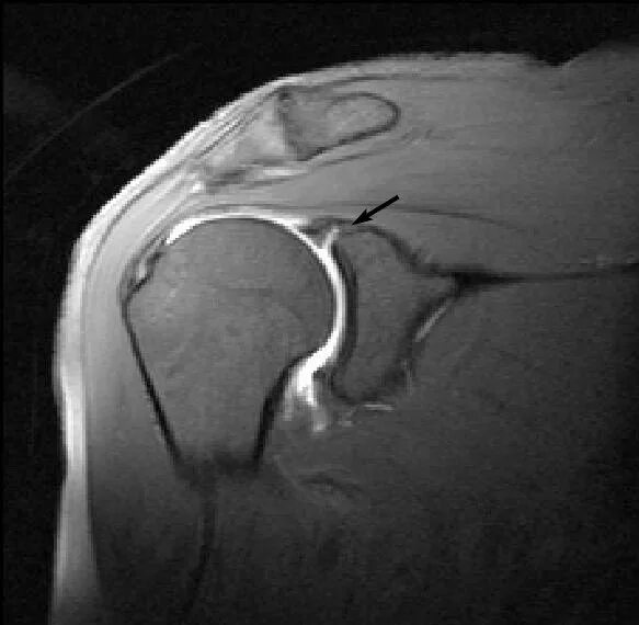 Слап разрыв плечевого сустава мрт. Надрыв суставной губы плечевого сустава мрт. Банкарта плечевого сустава мрт. Разрыв капсулы плечевого сустава мрт.