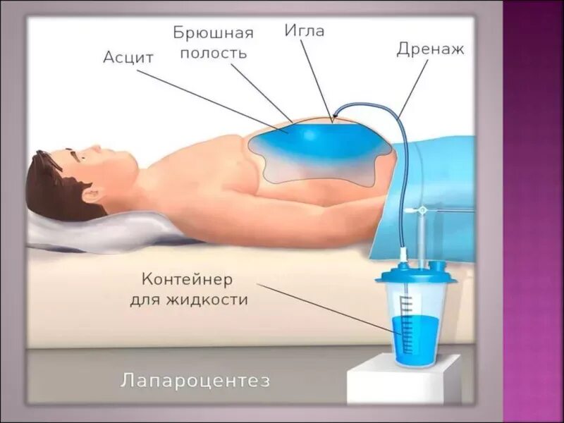 Лечение водой печень. Лапароцентез при асците. Выкачивание жидкости из брюшной полости.