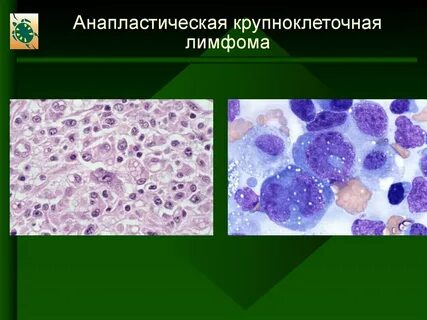 Диффузная в крупноклеточная лимфома клинические рекомендации