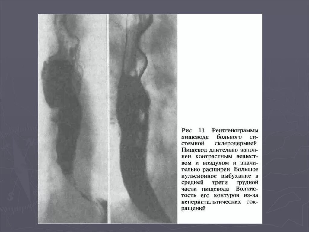 Н з пищевода. Поражение пищевода при системной склеродермии. Склеродермия пищевода рентген. Гипотония пищевода рентген. Склеродермия рентген желудка пищевода изменения.