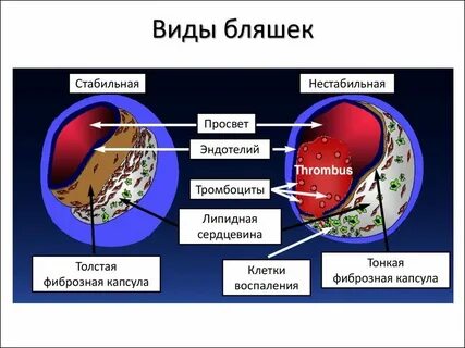 Что значит бляшки