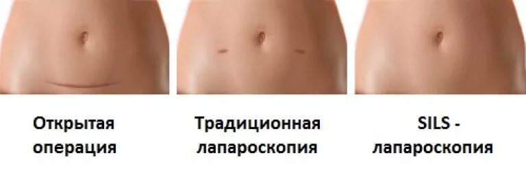 Лапароскопия через сколько можно беременеть. Лапароскопия в гинекологии шрамы. лапароскопия яичника шрамы. шрам после операции на матке. шрамы после лапароскопии матки.