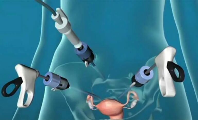 Внематочная беременность лапароскопия. Лапароскопия кист яичников. Операция внематочной беременности лапароскопии. Лапароскопия тубэктомия. Удаление матки гинеколог