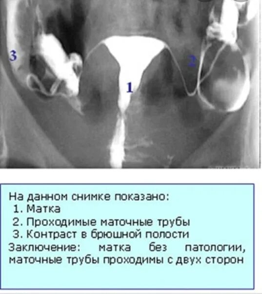 МСГ маточных труб непроходимость. Гистеросальпингография маточных труб. Проходимость маточных труб норма. На узи видна труба