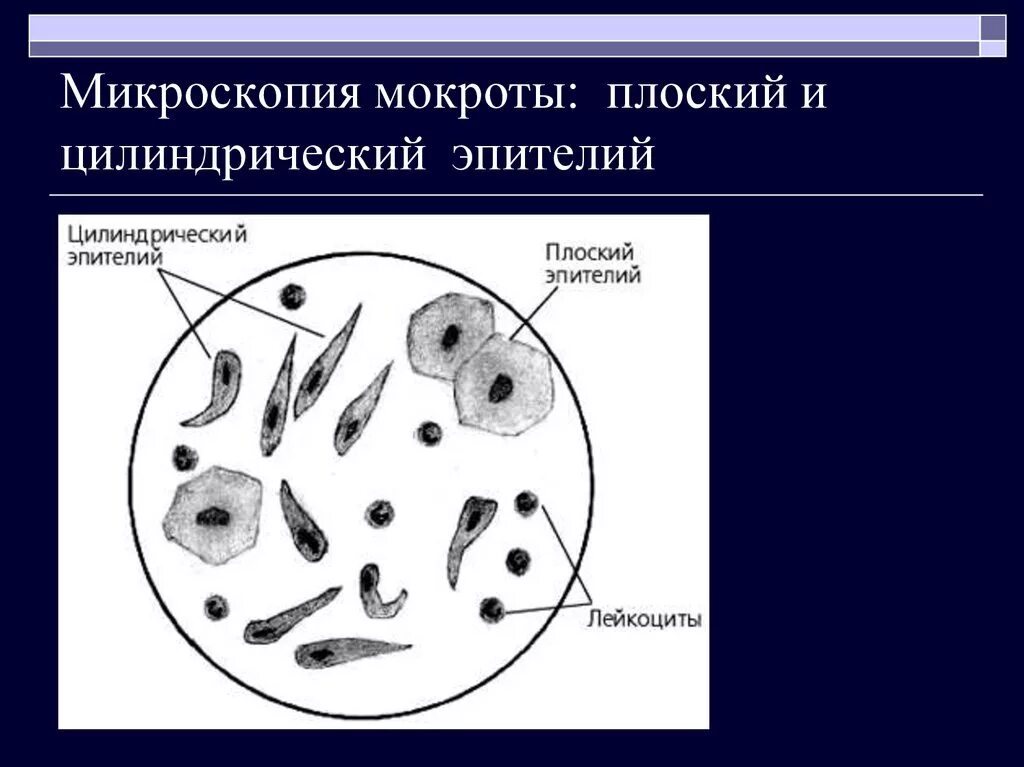 Мокрота нативный препарат микроскопия. Клетки мокроты нативный препарат. Микроскопическое исследование нативного препарата мокроты. Клетки при микроскопии мокроты.