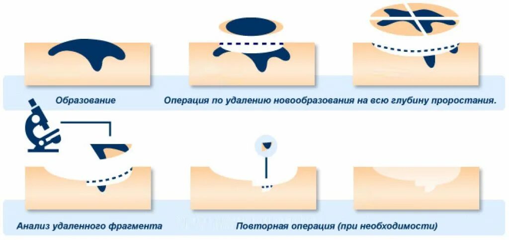 Доброкачественные новообразования кожи. Иссечение новообразования. Заживление удаленной родинки. Рецидив у мужчин