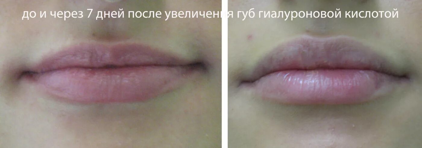 Через сколько сойдет. Зажившие губы после гиалуроновой кислоты 1 мл. Пупырышки после увеличения губ гиалуроновой кислотой. Отек после увеличения губ.