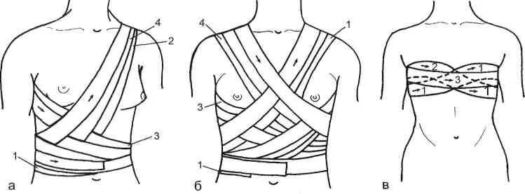 Повязка на молочные железы алгоритм. Наложение бинтовой повязки на левую молочную железу. Наложите бинтовую повязку на молочную железу.. Бинтовая повязка поддерживающая на молочную железу. Десмургия повязка на молочную железу.