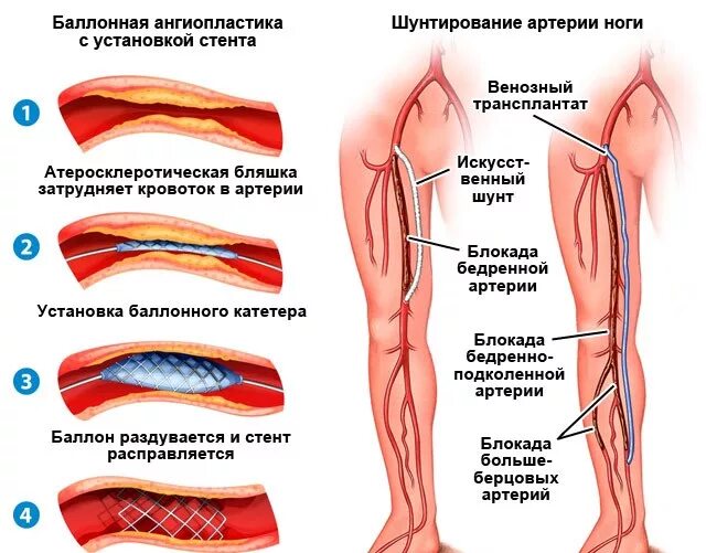 Шунтирование атеросклероза. Баллонная ангиопластика артерий нижних конечностей ход операции. Шунт артерии нижних конечностей. Атеросклероз артерий нижних конечностей (синдром Лериша).