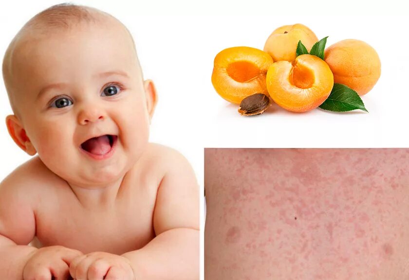 Есть ли аллергия на яблоки. Пищевая аллергия сыпь у грудничка. Пиуевая аллергия у ребёнка.