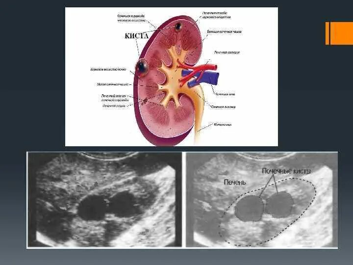 Кистозная форма почечной карциномы. Злокачественная киста почки. Киста печени форум