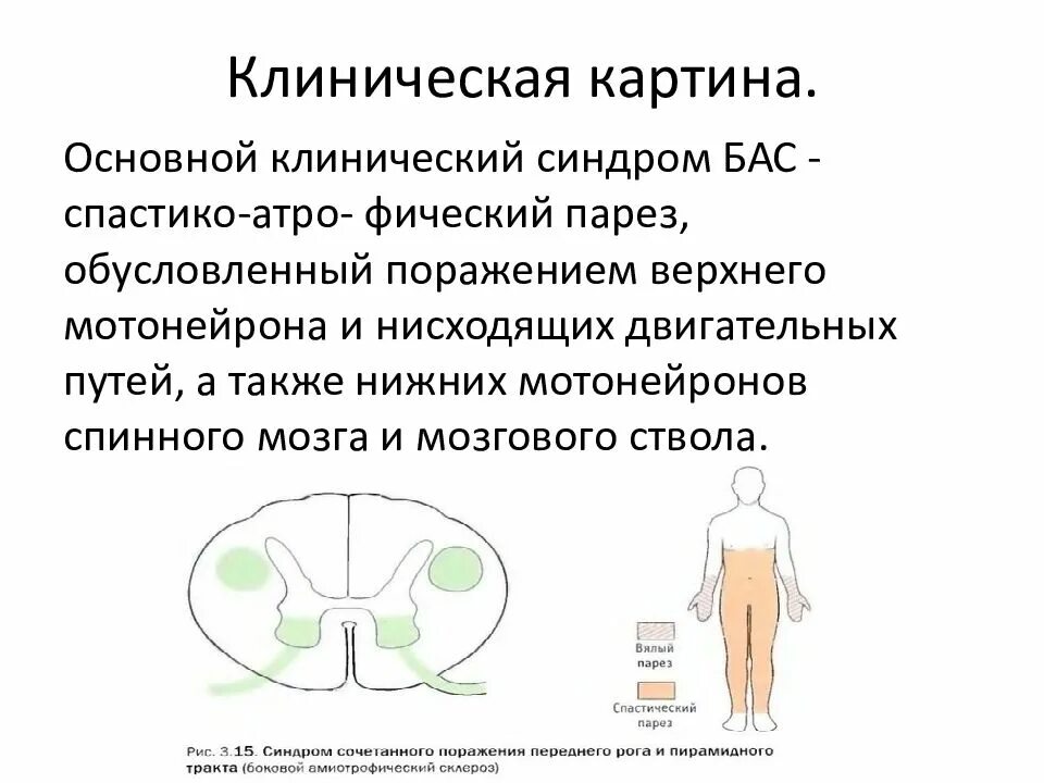 Синдром бас причины. Боковой амиотрофический склероз презентация. боковой амиотрофический склероз клиническая картина. бас синдром неврология.